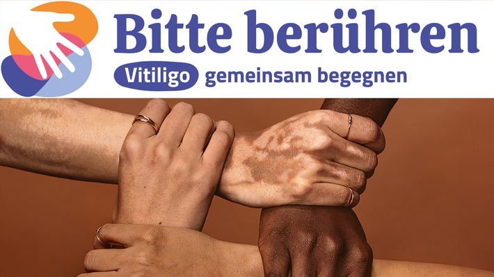 „Bitte berühren“ – Kampagnenstart zum Welt-Vitiligo-Tag